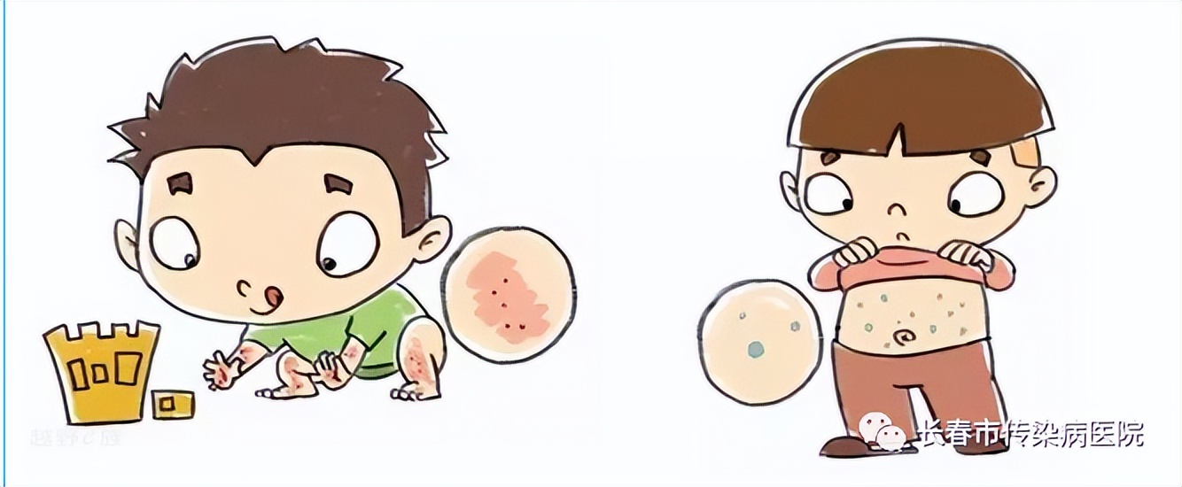 春季传染病麻疹的预防知识图片,健康科普儿童荨麻疹护理