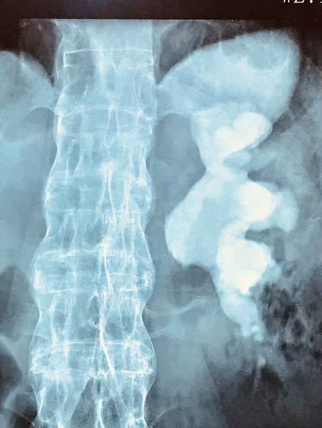 结石尿出来就好了吗,输尿管结石95mm结石能排出吗