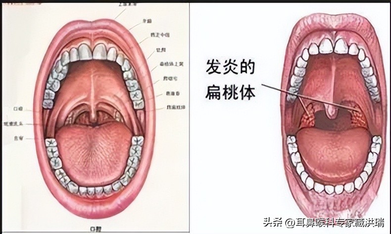 扁桃体肥大一年发烧几次算不正常,耳鼻喉科扁桃体肥大怎么治疗