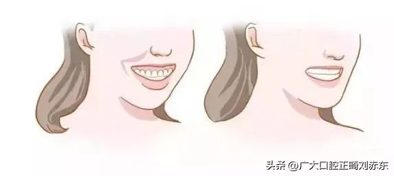 嘴凸要做正畸还是正颌,嘴凸下巴后缩应该正畸还是正颌