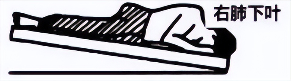 排痰手法由内向外,体位引流与排痰操作的流程视频