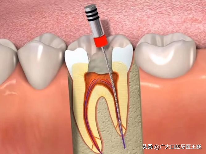 根管治疗后注意事项模板,口腔根管治疗的干货知识