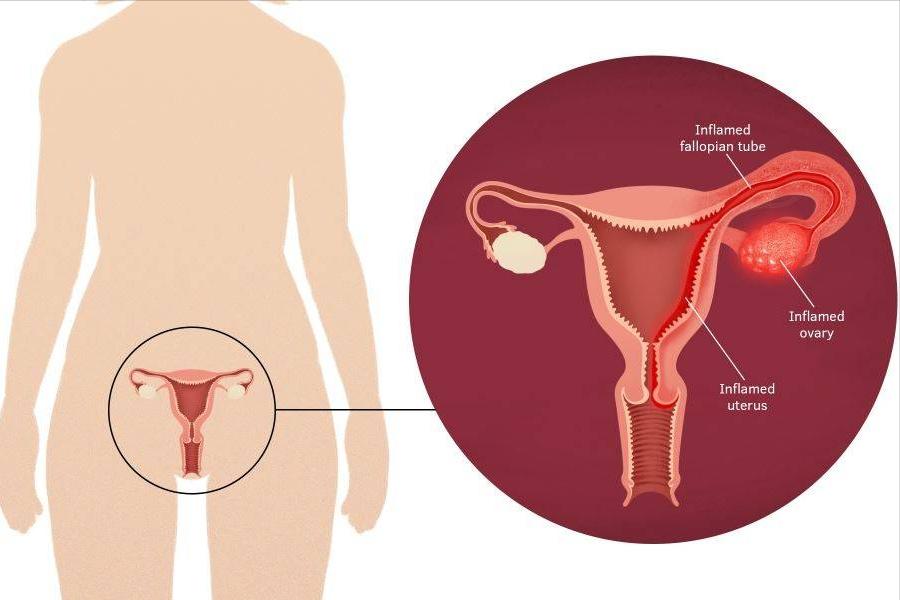 治盆腔炎哪种活血化瘀效果好,治疗慢性盆腔炎是中药还是西药好