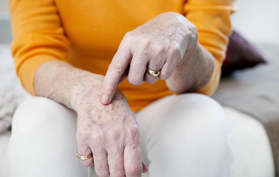 老年斑红霉素可以去除吗,老年斑红霉素