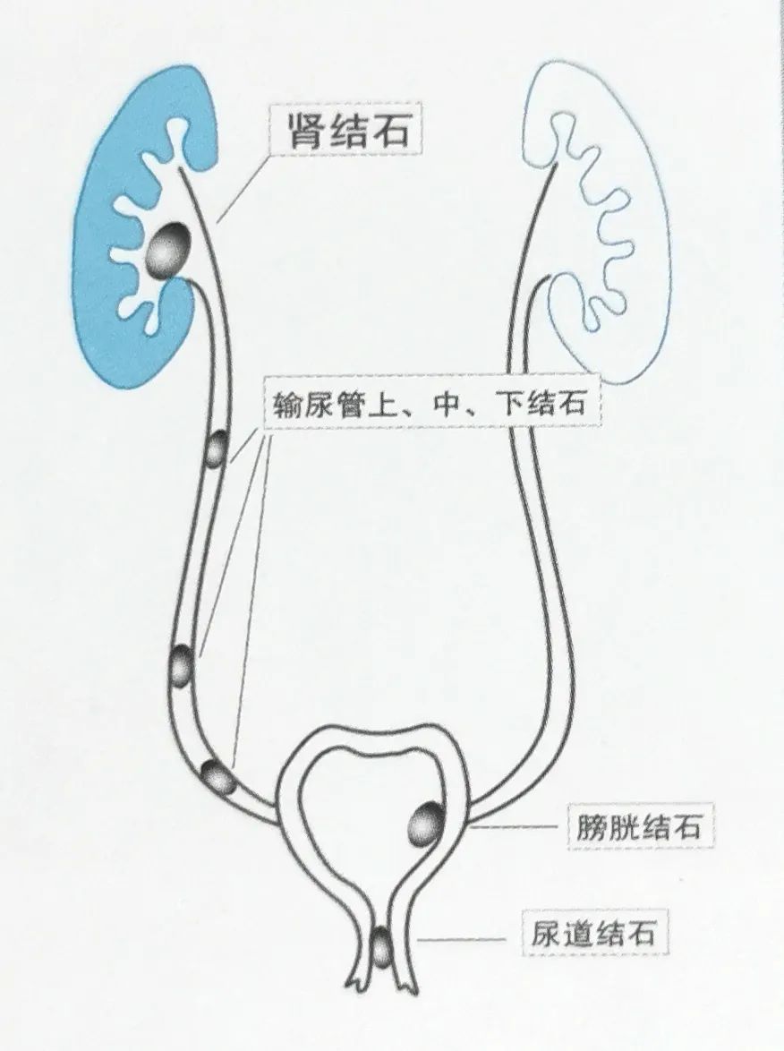 输尿管结石疼得厉害如何缓解,输尿管结石疼起来要命