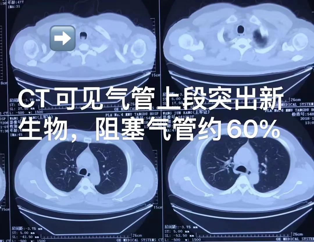 上气道狭窄治疗,气道狭窄致命吗