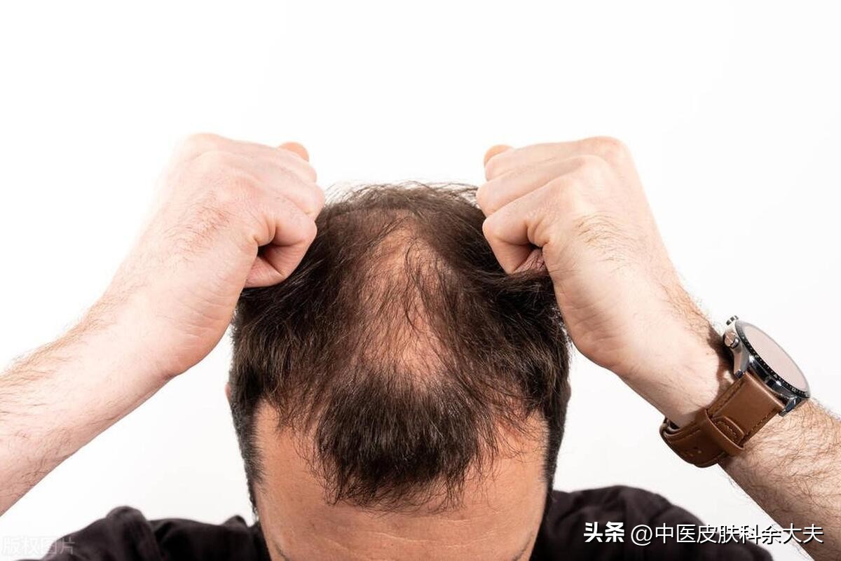 头皮屑多脱发中医辨证,脱发头屑痒偏方