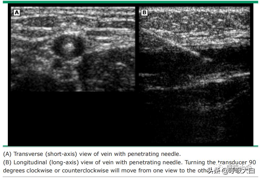 深静脉穿刺股静脉步骤,深静脉穿刺置管术视频教程