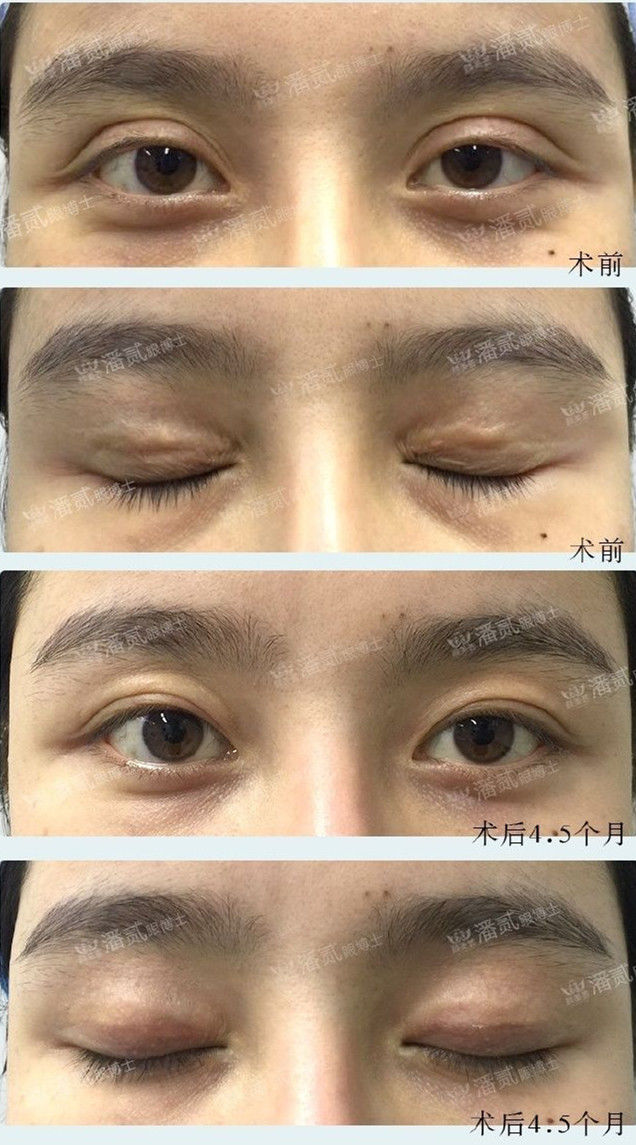 埋线双眼皮如果不满意怎么修复,切开双眼皮失败可以用埋线修复吗