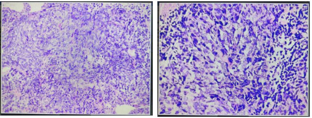 斯鲁利单抗治疗小细胞肺癌生存期,小细胞肺癌3a期用斯鲁利单抗