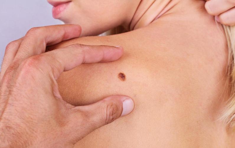 警惕这些痣可能会成瘤,哪些地方有痣代表得癌症了