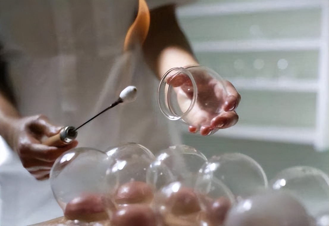 拔火罐吸出来的是湿气还是毒素,拔火罐吸出来的瘀血是体内毒素吗