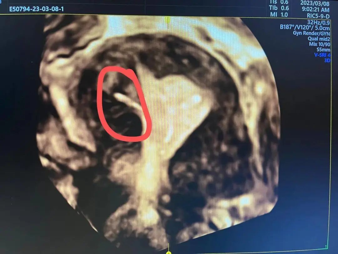 女性身体里被遗忘的节育环,被遗忘在女性体内的节育环