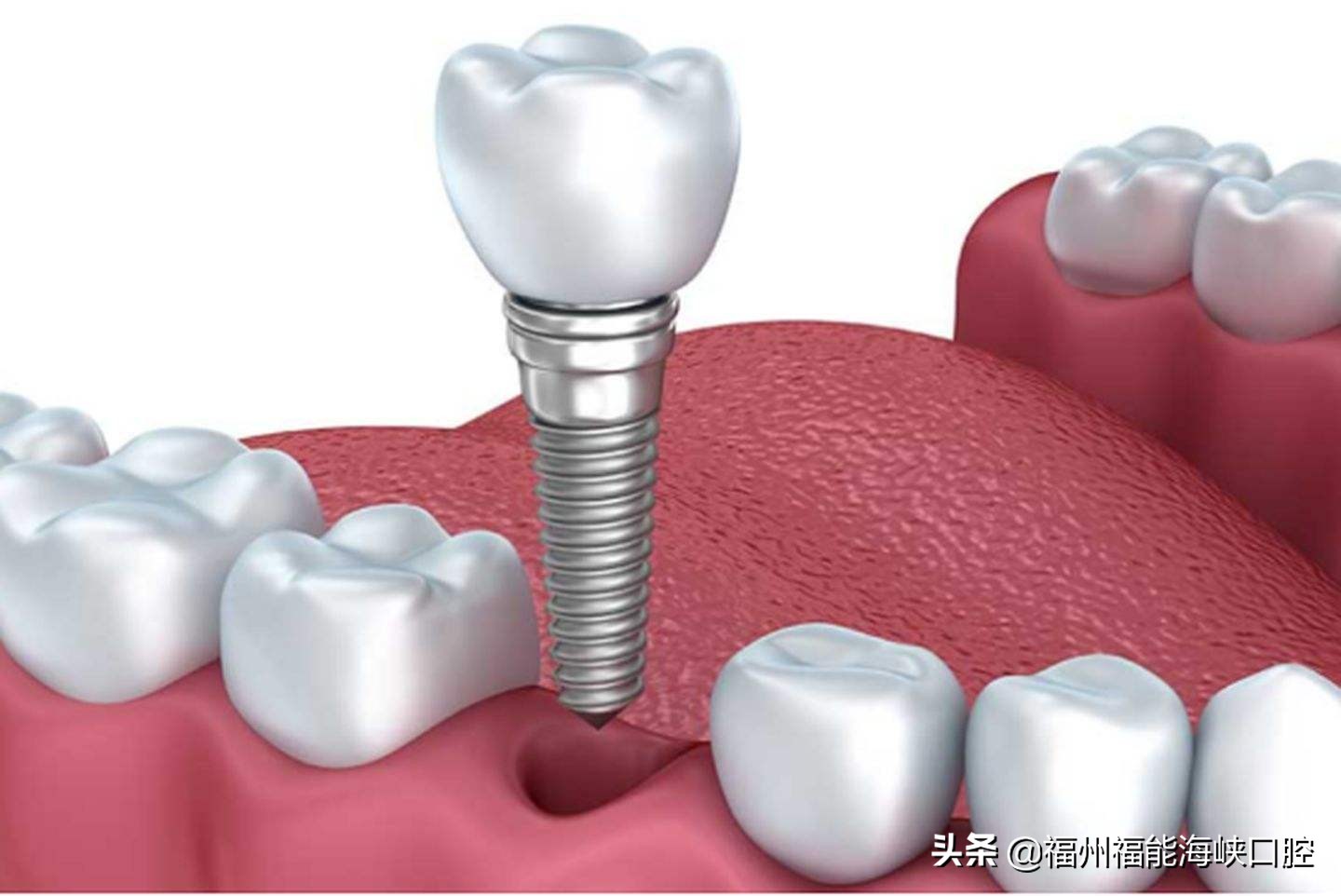 牙齿松动缺失全口修复要多少钱,牙齿缺失的最佳修复方法