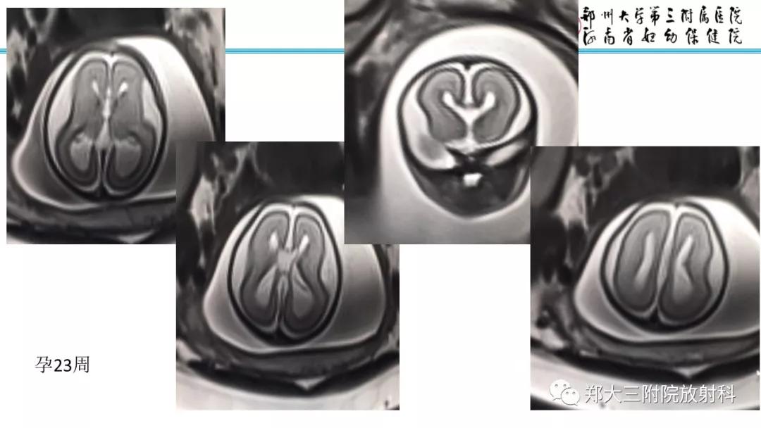 透明隔腔主要是判断什么,透明隔腔宽约10mm什么意思