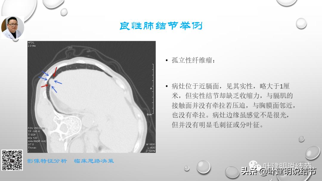 在《一脉阳光》呼吸影像诊断专题培训班上的讲课PPT（第一部分）
