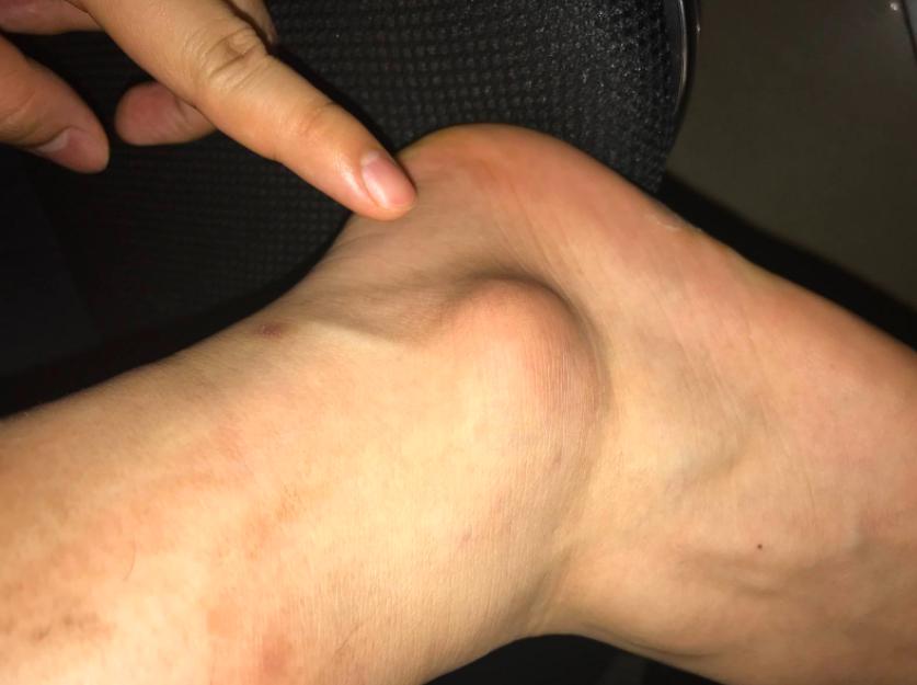 5岁男孩急性肾衰竭新闻,5岁男孩突发肾衰竭