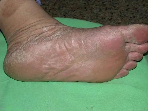 甲癣不严重怎么治疗,甲易生治疗灰指甲吗