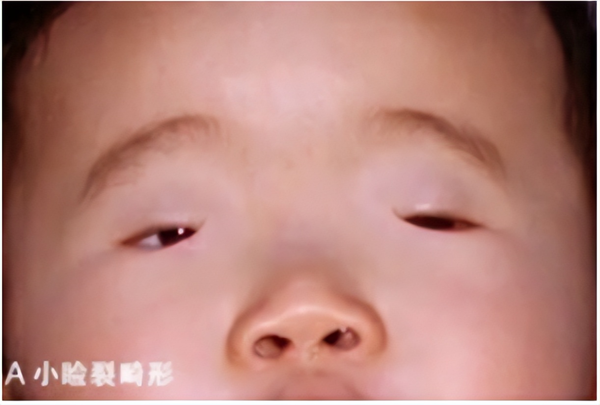 河南两兄弟割双眼皮被劝退,郑州割双眼皮失败男子