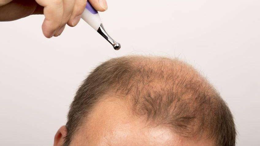 脱发为什么都是从头顶先秃,脱发为什么先从头顶脱