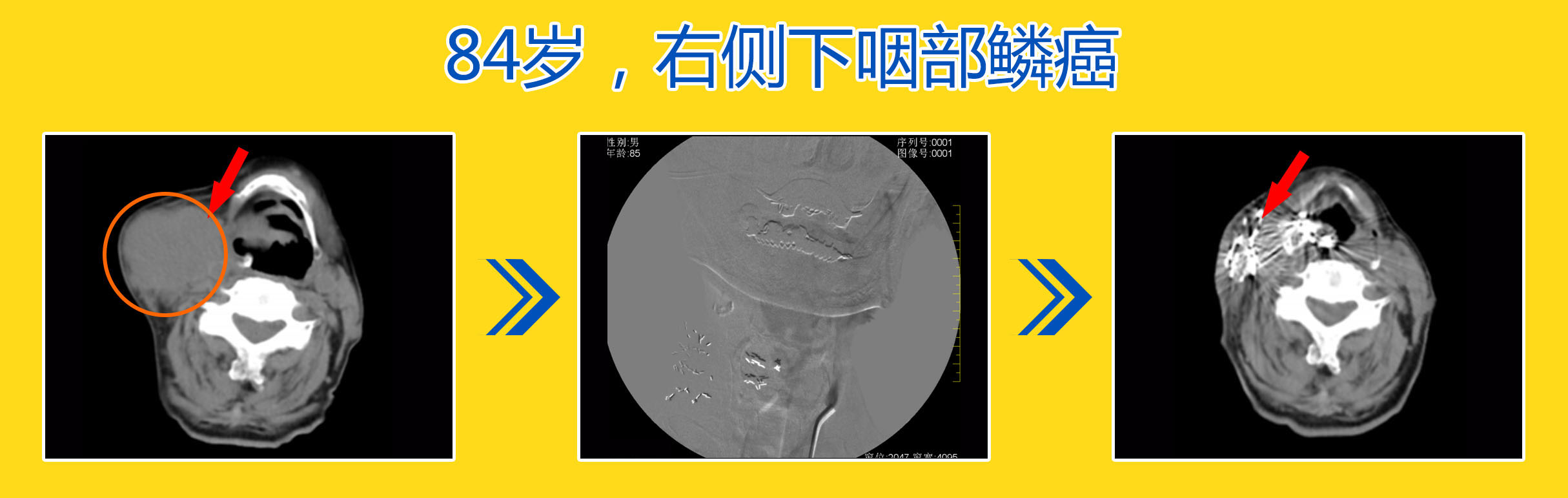 粒子植入术：一根针“排兵布阵”，精准剿灭癌细胞
