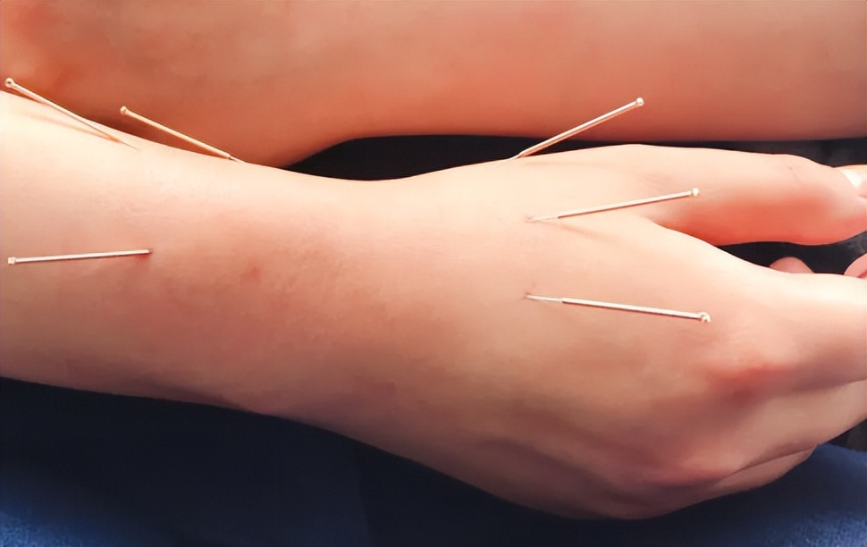 85岁关节疼痛针灸治疗有用吗,手关节处疼痛针灸