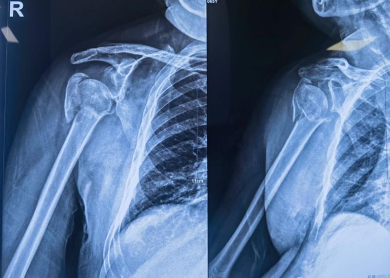 肱骨近端骨折属于几级伤残,肱骨近端骨折康复训练技巧