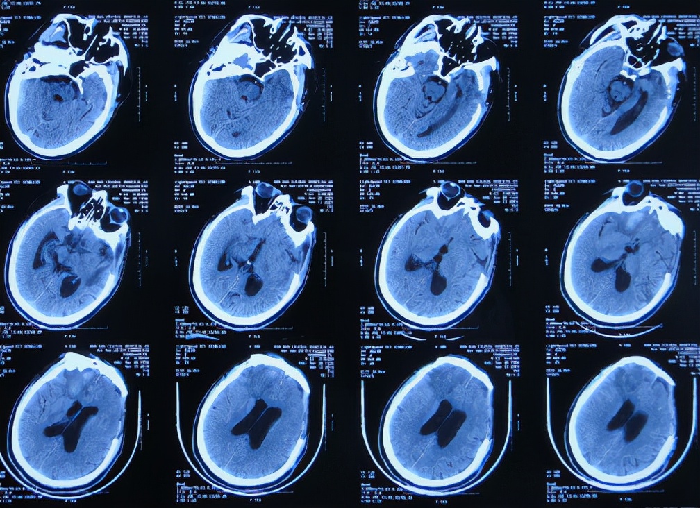 脑外伤后硬膜下积液颅骨修补,颅骨修复手术失败导致脑积水