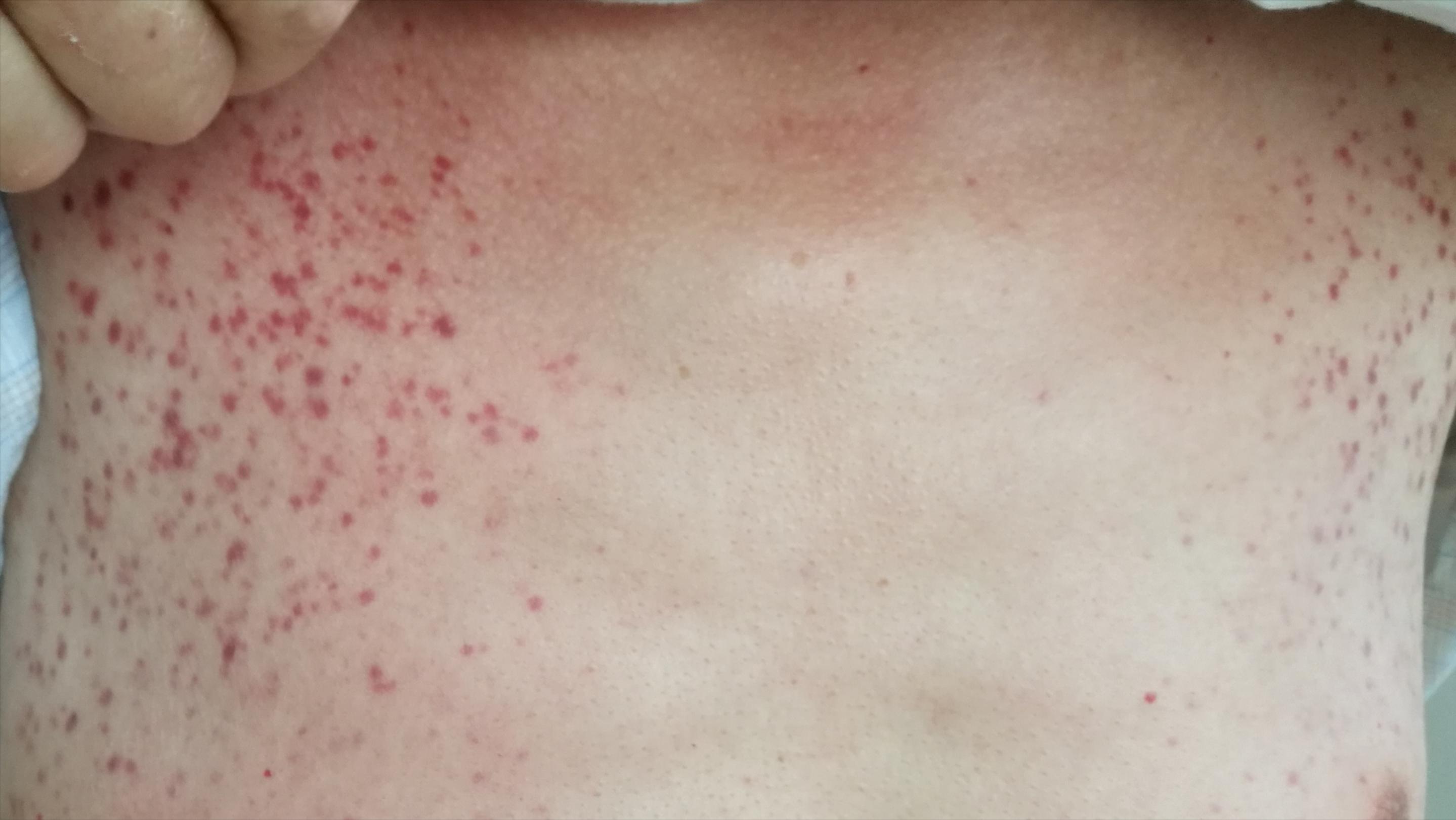 对镍过敏是怎么回事,镍过敏的人多不多