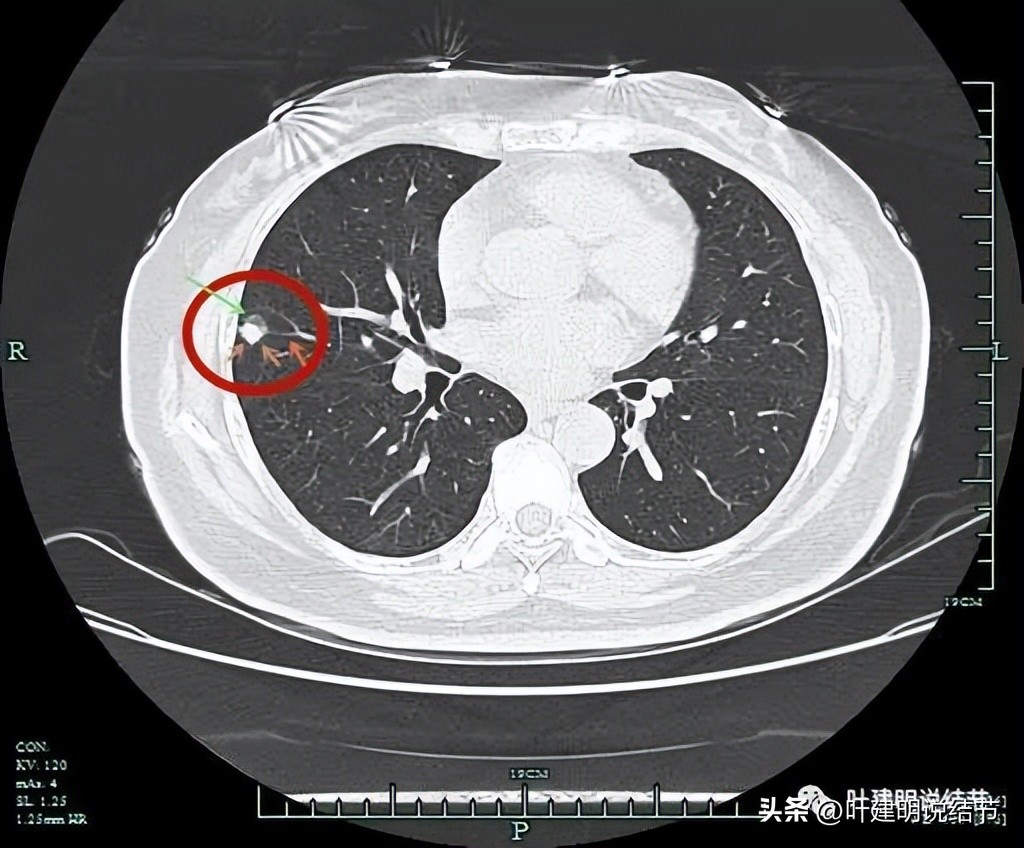 子宫内膜癌术后病灶大于二厘米,子宫内膜癌手术后一年又发现肺癌