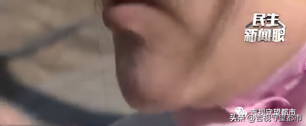 做完填充1年水肿,面部取出填充物手术