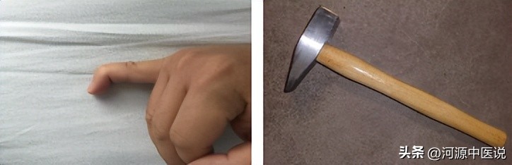 打篮球戳到手指后的治疗方法,打篮球戳到手肿胀怎么回复