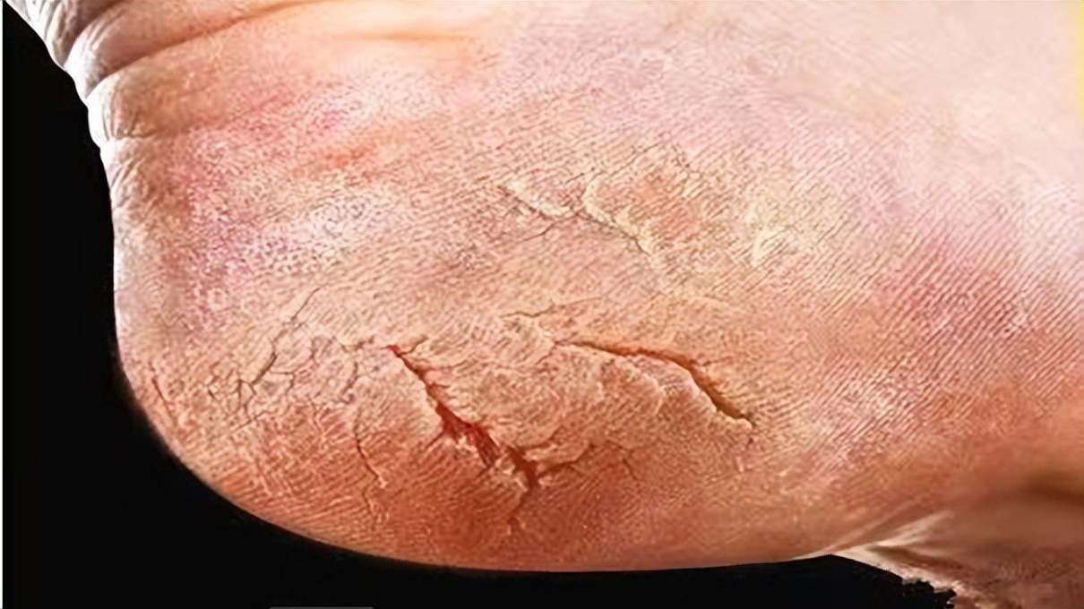 脚后跟干裂可能与这4个原因有关,脚后跟总干裂原来是这3个原因
