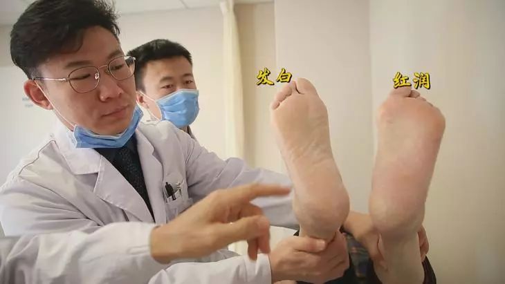 动脉粥样硬化正确走路视频,下肢动脉粥样硬化的有效锻炼方法