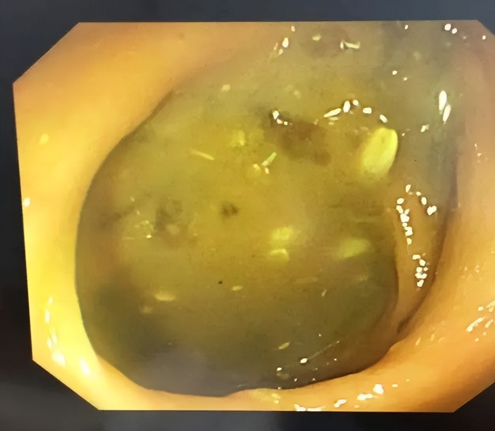 肠道准备不满意影响视野,肠道准备不充分肠镜会漏诊吗