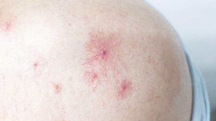 再三提醒,这三个地方有痣是癌症的前兆