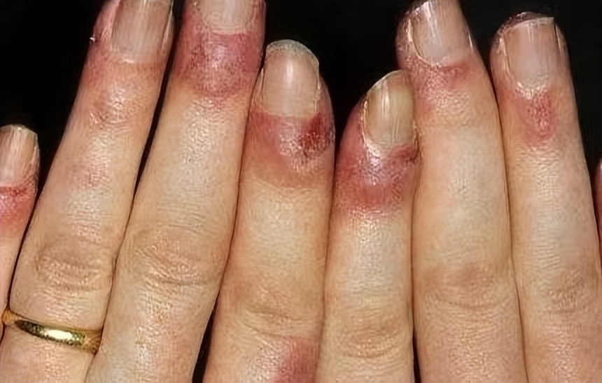 风湿免疫类疾病最怕什么,风湿免疫疾病如何预防