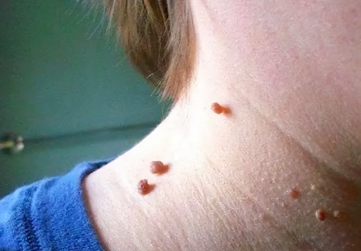 皮肤长小肉球用什么药膏,皮肤长的小肉球怎么自己处理