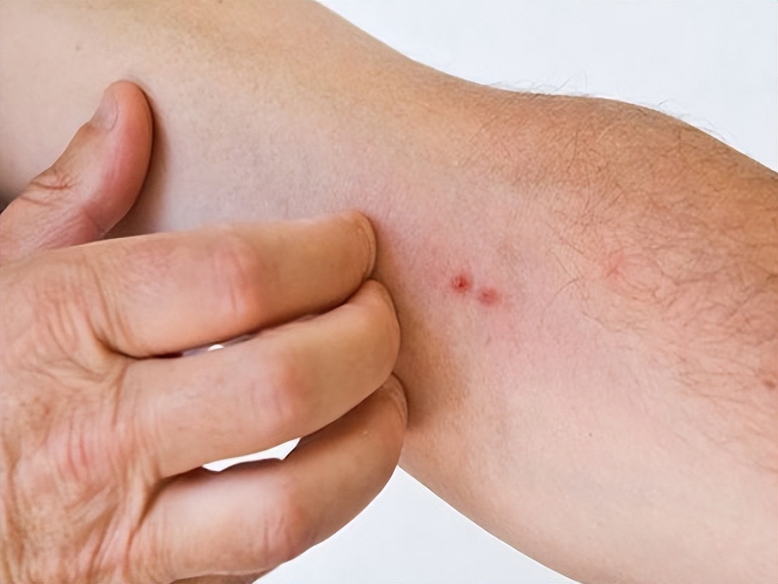 神经性皮炎喝过中药后为啥更痒,手越抓越痒是皮炎还是真菌感染