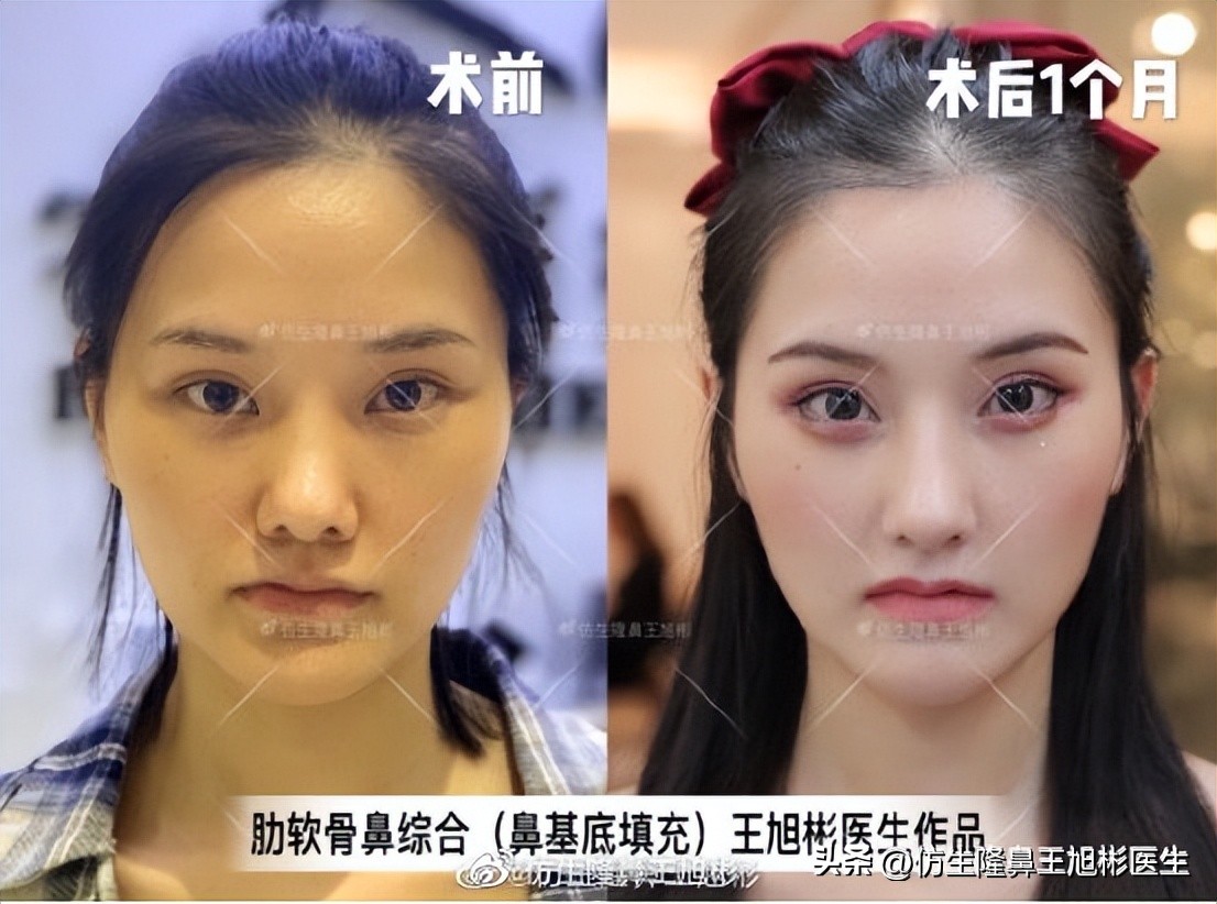 隆鼻鼻型科普,鼻基底凹陷隆鼻可以改善吗