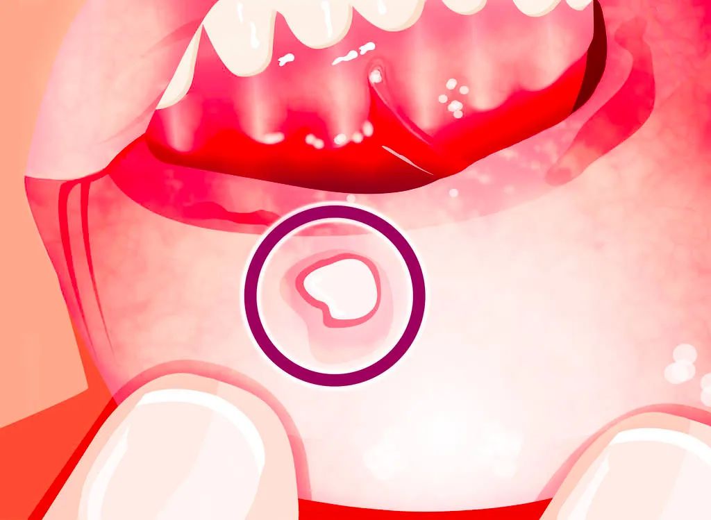 体内有癌嘴先知,体内有癌症嘴巴先知