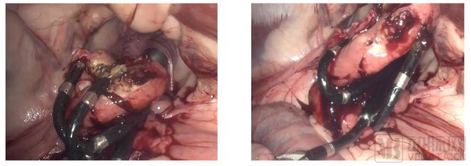 体内柔性手术机器人,首台介入手术机器人