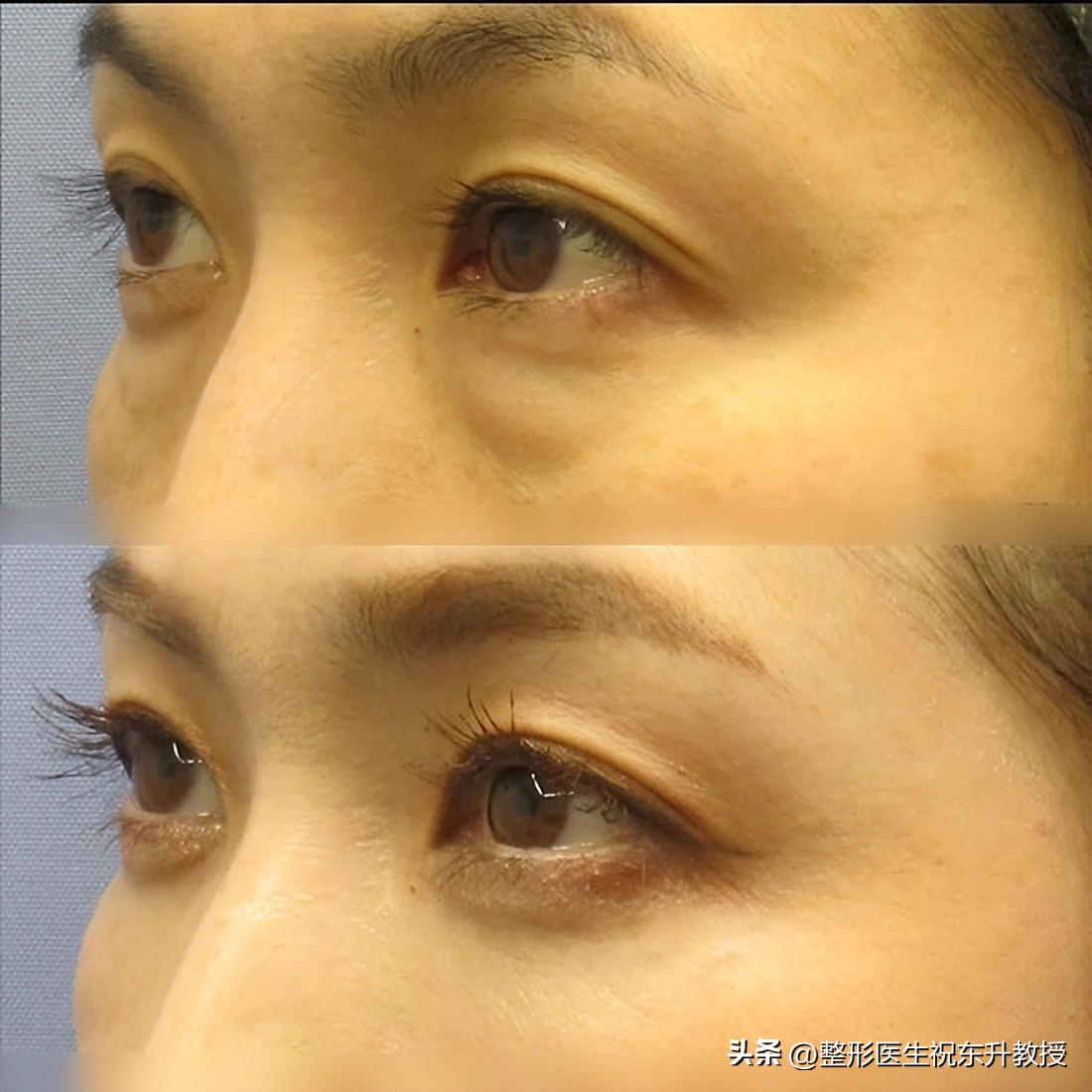 手术祛眼袋会有什么后遗症,超声波祛眼袋有什么后遗症