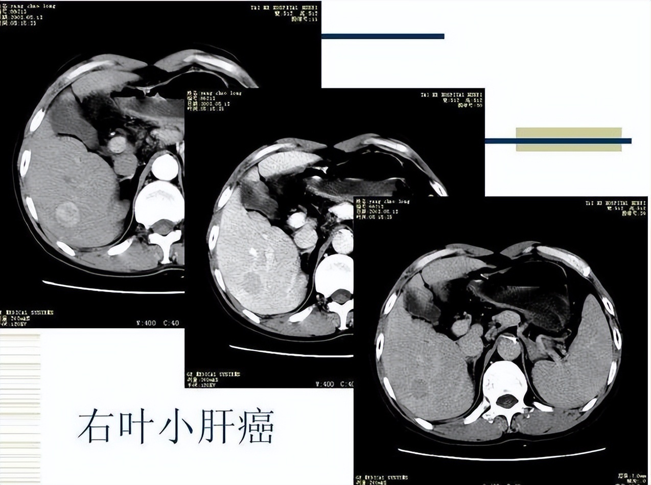 肝脏肿瘤一般长到5cm要几年,肝脏肿瘤几公分会有症状
