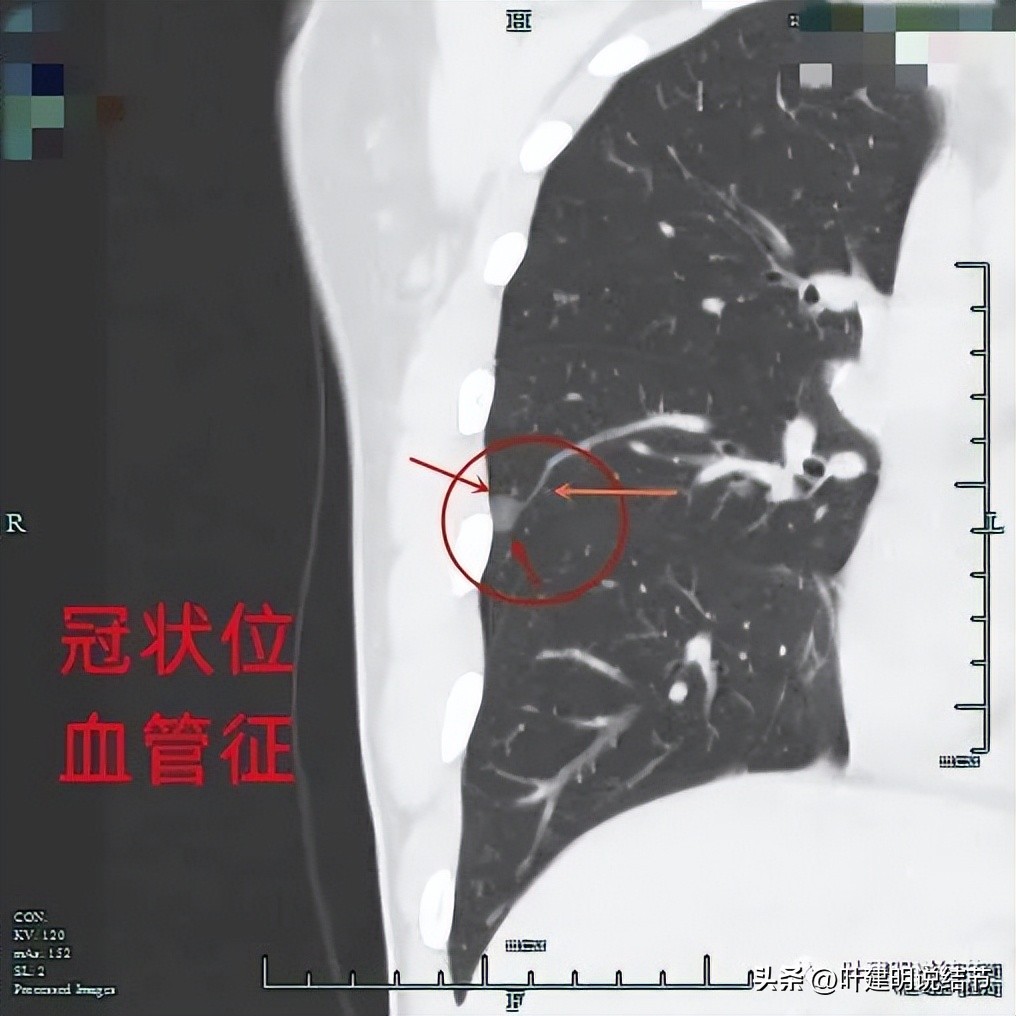 中叶多发微小结节,男性30岁右侧甲状腺单发结节