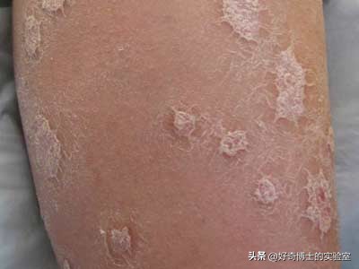 女生大腿外侧出现小条纹,为什么女生大腿上会有条纹