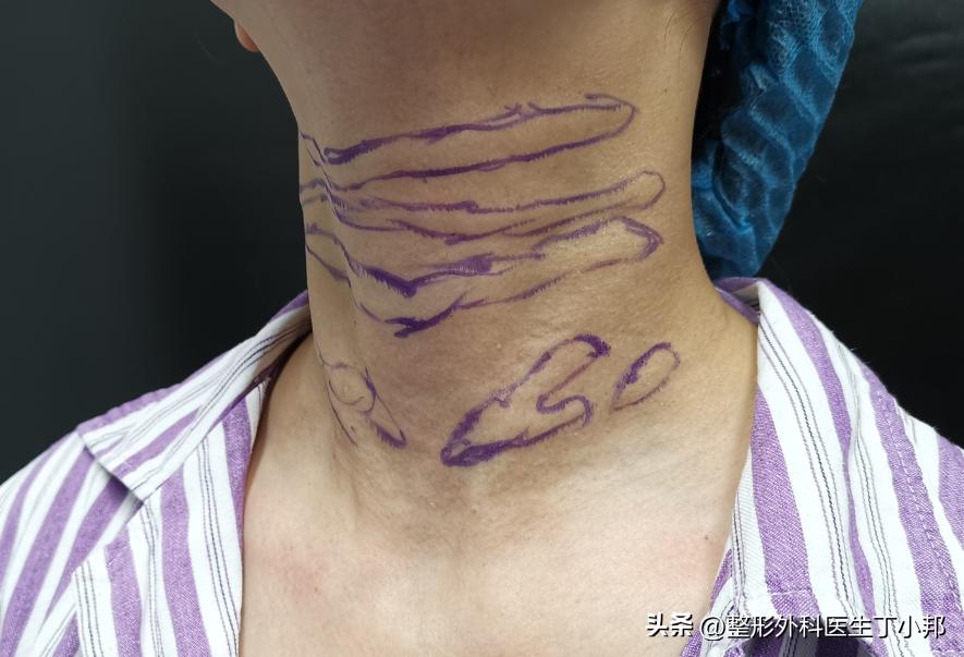 玻尿酸注射鼓包是医疗事故吗,注射玻尿酸有鼓包是怎么回事视频