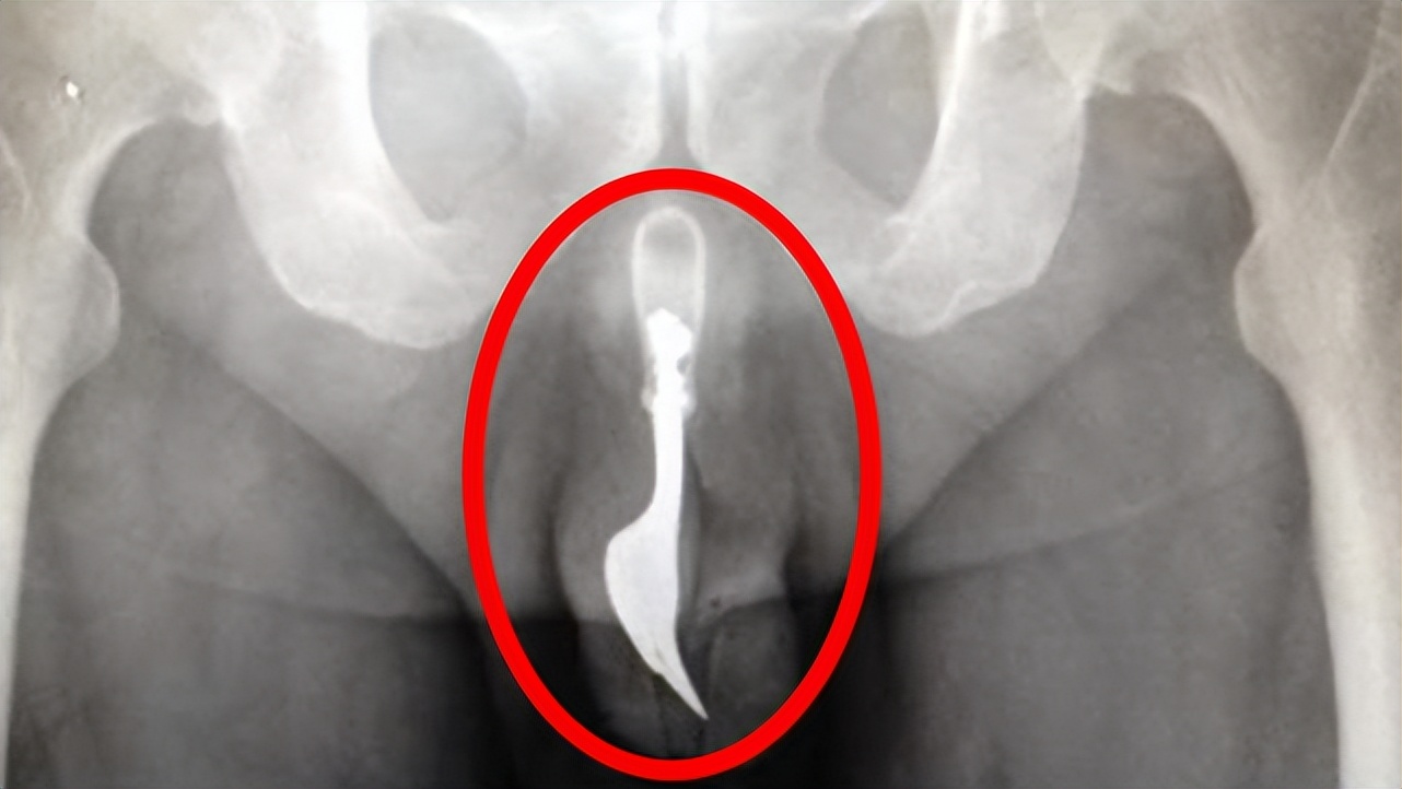 巴西惊现“吸血鬼鱼”！攻击人的隐私部位，将寄主吸食干净才离开