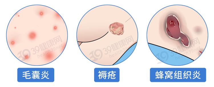 阿莫西林是好药但只对四种病有效,阿莫西林别滥用只针对这六种病