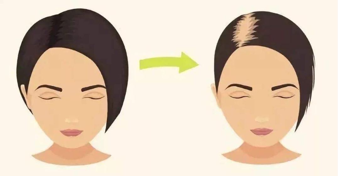 脱发怎么办如何拯救你的头发,脱发怎么拯救头皮毛囊